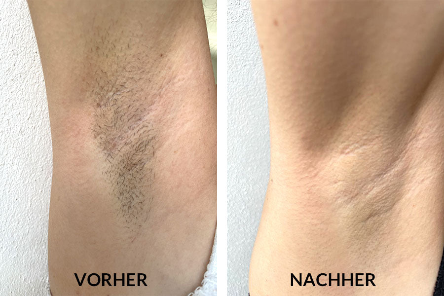 ClearSkin® IPL Haarentfernung